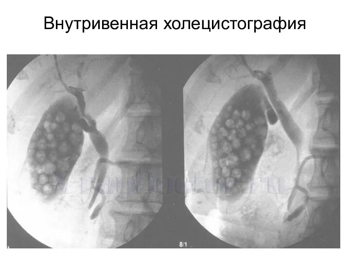 Внутривенная холецистография