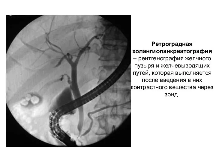 Ретроградная холангиопанкреатография – рентгенография желчного пузыря и желчевыводящих путей, которая