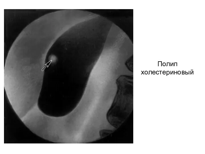 Полип холестериновый