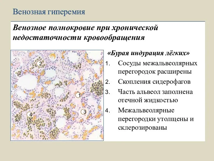 «Бурая индурация лёгких» Сосуды межальвеолярных перегородок расширены Скопления сидерофагов Часть