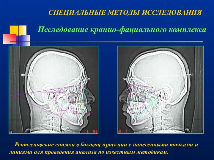 Исследование кранио-фациального комплекса Рентгеновские снимки в боковой проекции с нанесенными