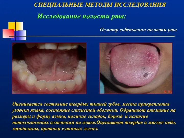 СПЕЦИАЛЬНЫЕ МЕТОДЫ ИССЛЕДОВАНИЯ Осмотр собственно полости рта Исследование полости рта: