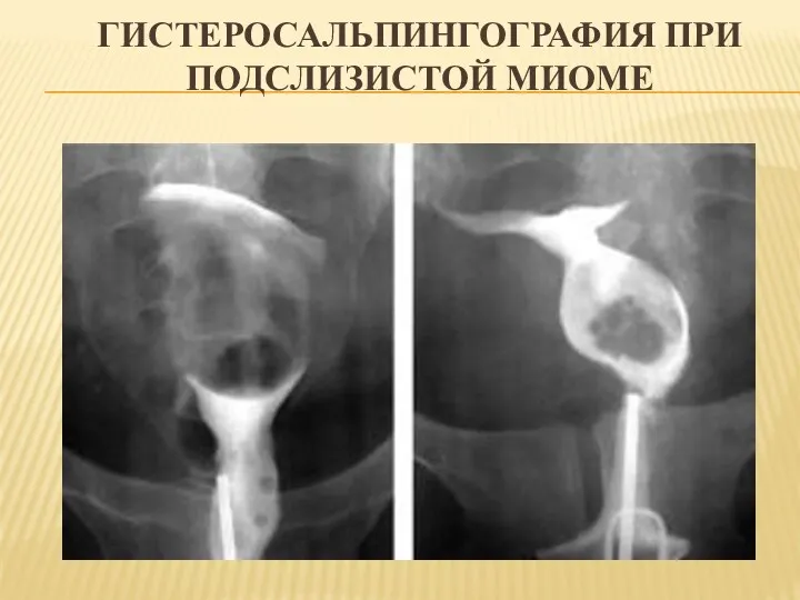 ГИСТЕРОСАЛЬПИНГОГРАФИЯ ПРИ ПОДСЛИЗИСТОЙ МИОМЕ