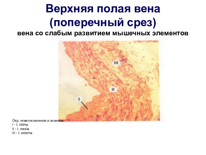 Верхняя полая вена (поперечный срез) вена со слабым развитием мышечных