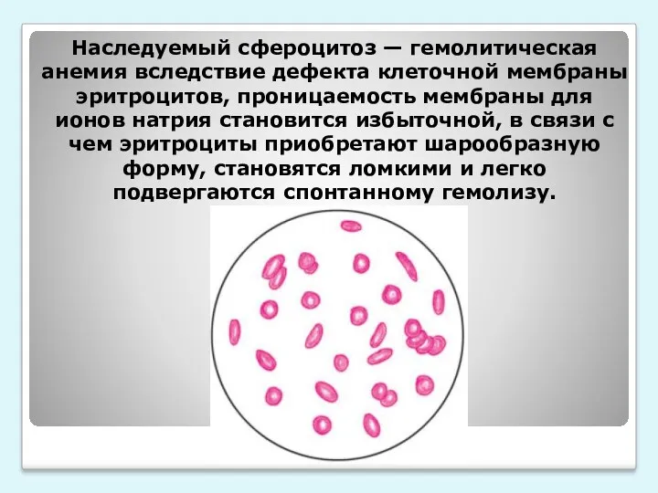 Наследуемый сфероцитоз — гемолитическая анемия вследствие дефекта клеточной мембраны эритроцитов,