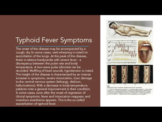 Typhoid Fever Symptoms The onset of the disease may be