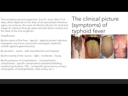 The clinical picture (symptoms) of typhoid fever The incubation period