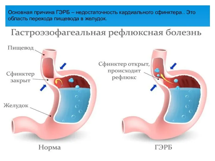 Основная причина ГЭРБ – недостаточность кардиального сфинктера.. Это область перехода пищевода в желудок.