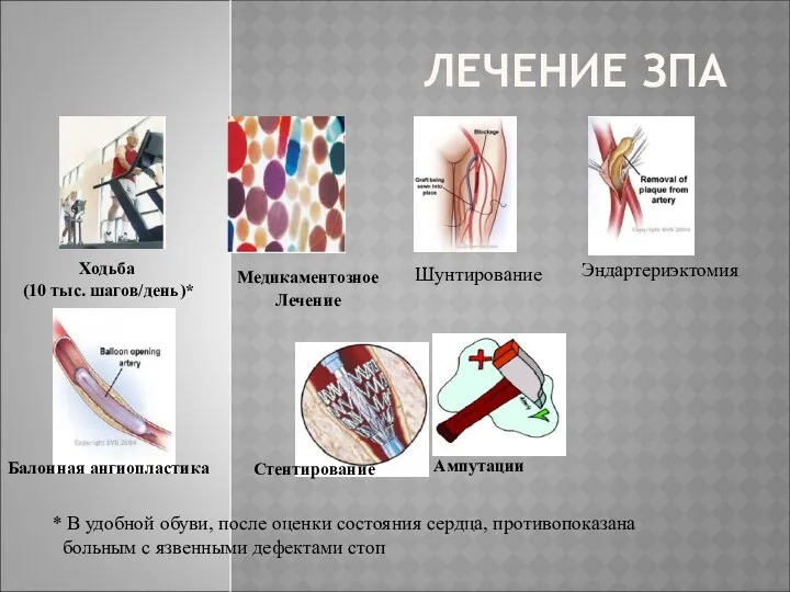 ЛЕЧЕНИЕ ЗПА Ходьба (10 тыс. шагов/день)* * В удобной обуви,