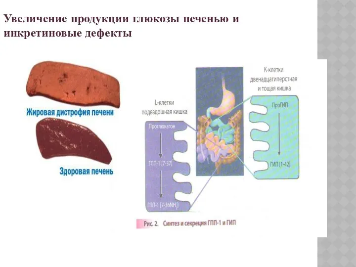 Увеличение продукции глюкозы печенью и инкретиновые дефекты