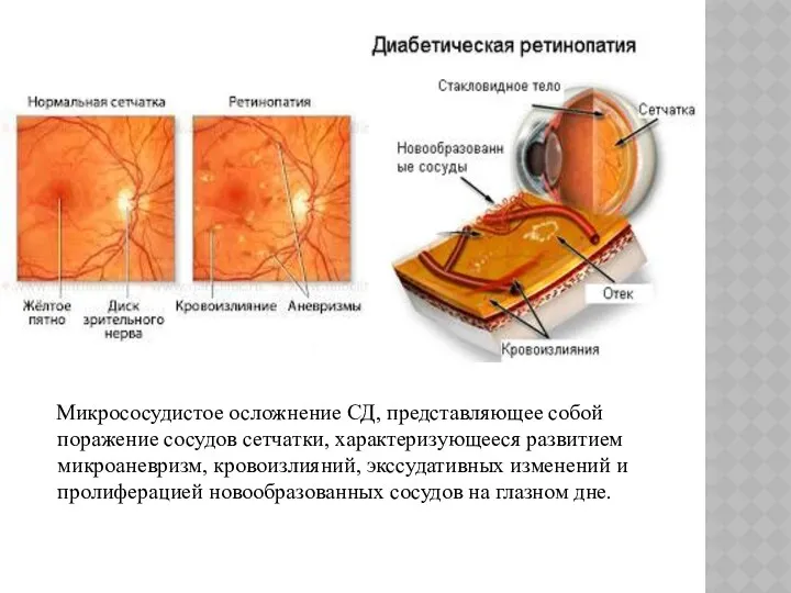 Микрососудистое осложнение СД, представляющее собой поражение сосудов сетчатки, характеризующееся развитием
