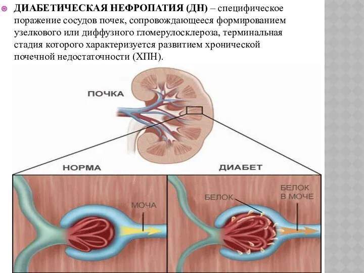 ДИАБЕТИЧЕСКАЯ НЕФРОПАТИЯ (ДН) – специфическое поражение сосудов почек, сопровождающееся формированием