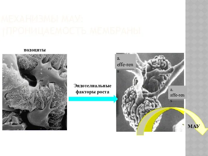 МЕХАНИЗМЫ МАУ: ↑ПРОНИЦАЕМОСТЬ МЕМБРАНЫ a. affe-rens a. effe-rens подоциты Эндотелиальные факторы роста МАУ