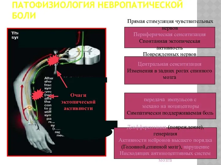 ПАТОФИЗИОЛОГИЯ НЕВРОПАТИЧЕСКОЙ БОЛИ Очаги эктопической активности Прямая стимуляция чувствительных нервов