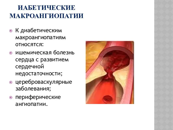 ИАБЕТИЧЕСКИЕ МАКРОАНГИОПАТИИ К диабетическим макроангиопатиям относятся: ишемическая болезнь сердца с