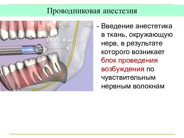 Проводниковая анестезия Введение анестетика в ткань, окружающую нерв, в результате