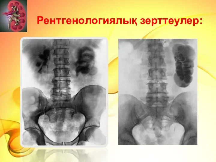 Рентгенологиялық зерттеулер: