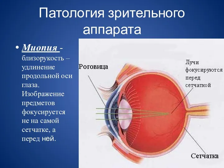 Патология зрительного аппарата Миопия - близорукость – удлинение продольной оси глаза. Изображение предметов