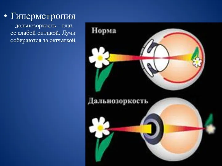 Гиперметропия – дальнозоркость – глаз со слабой оптикой. Лучи собираются за сетчаткой.