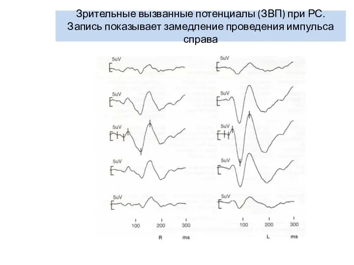 Зрительные вызванные потенциалы (ЗВП) при РС. Запись показывает замедление проведения импульса справа