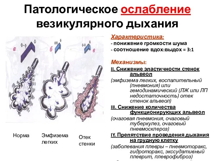 Патологическое ослабление везикулярного дыхания Характеристика: - понижение громкости шума -