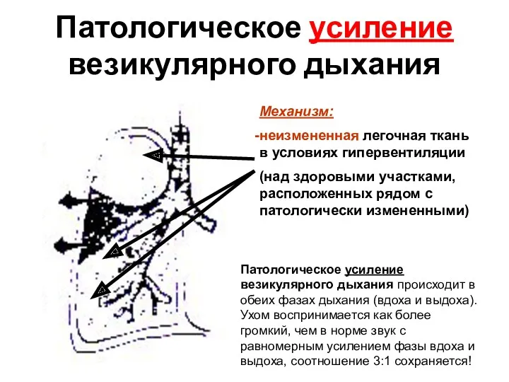 Патологическое усиление везикулярного дыхания Механизм: неизмененная легочная ткань в условиях