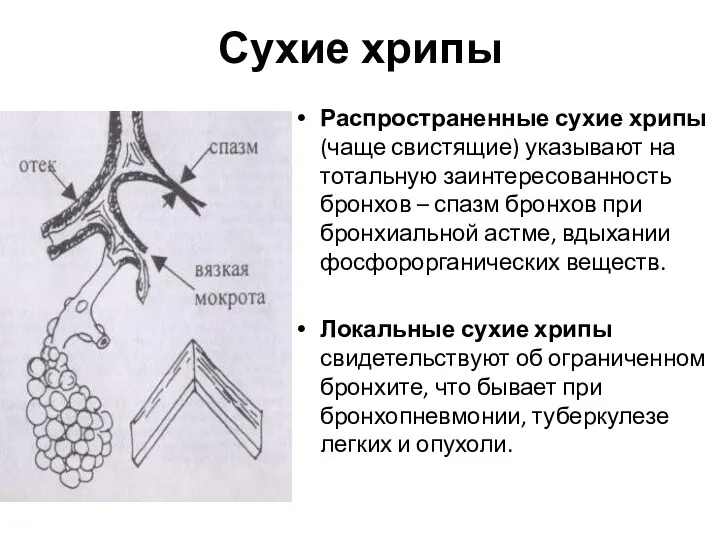 Сухие хрипы Распространенные сухие хрипы (чаще свистящие) указывают на тотальную