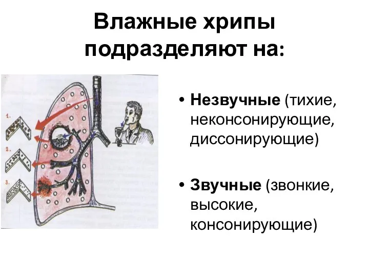 Влажные хрипы подразделяют на: Незвучные (тихие, неконсонирующие, диссонирующие) Звучные (звонкие, высокие, консонирующие)