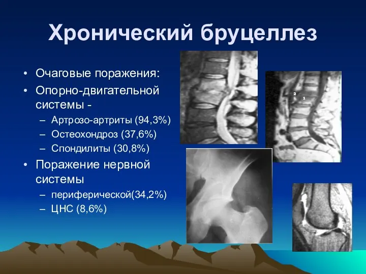 Хронический бруцеллез Очаговые поражения: Опорно-двигательной системы - Артрозо-артриты (94,3%) Остеохондроз