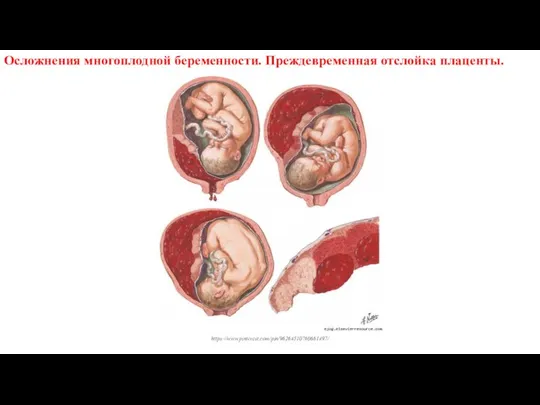Осложнения многоплодной беременности. Преждевременная отслойка плаценты. https://www.pinterest.com/pin/96264510760661497/