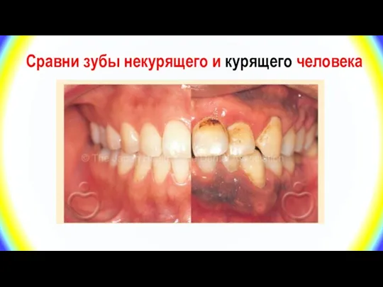 Сравни зубы некурящего и курящего человека