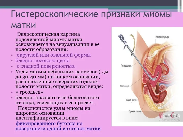 Гистероскопические признаки миомы матки Эндоскопическая картина подслизистой миомы матки основывается на визуализации в