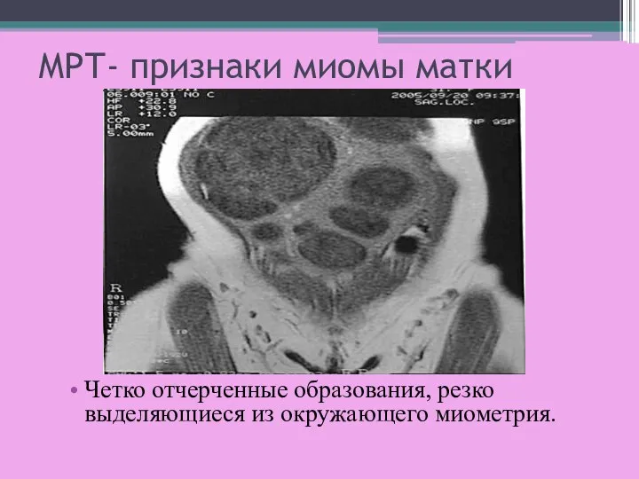 МРТ- признаки миомы матки Четко отчерченные образования, резко выделяющиеся из окружающего миометрия.
