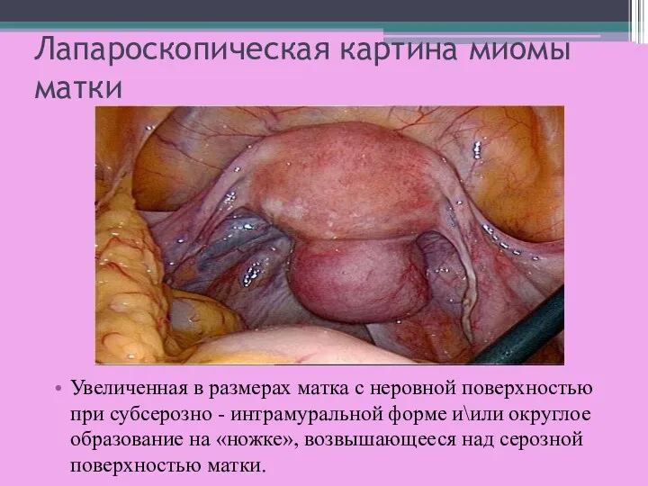 Лапароскопическая картина миомы матки Увеличенная в размерах матка с неровной