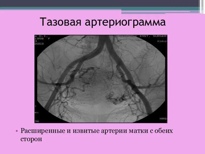 Тазовая артериограмма Расширенные и извитые артерии матки с обеих сторон