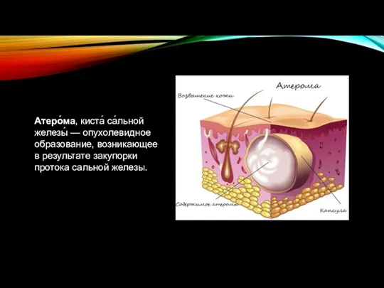 Атеро́ма, киста́ са́льной железы́ — опухолевидное образование, возникающее в результате закупорки протока сальной железы.
