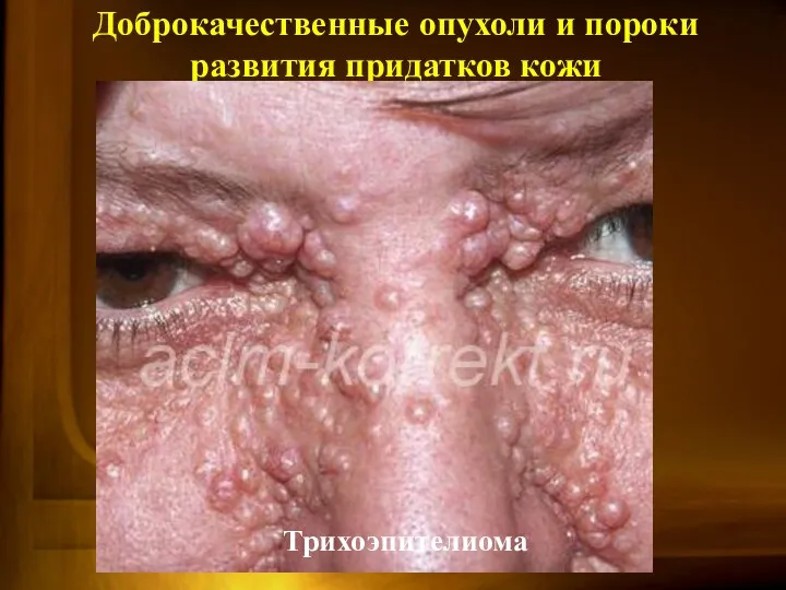 Доброкачественные опухоли и пороки развития придатков кожи эккринная порома Трихоэпителиома