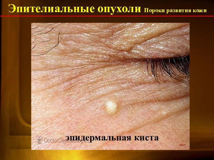 Эпителиальные опухоли Пороки развития кожи эпидермальная киста