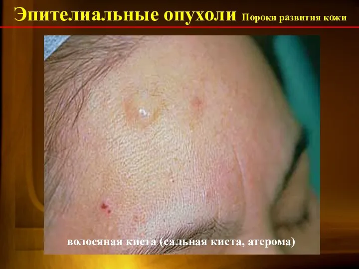 Эпителиальные опухоли Пороки развития кожи эпидермальная киста волосяная киста (сальная киста, атерома)