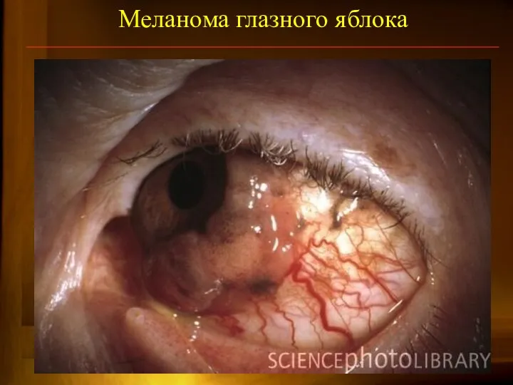 Меланома глазного яблока