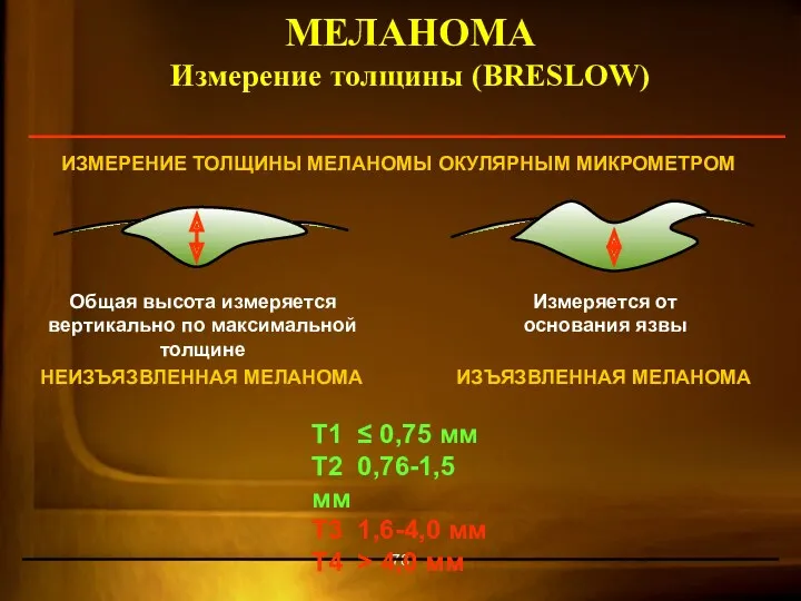 МЕЛАНОМА Измерение толщины (BRESLOW) ИЗМЕРЕНИЕ ТОЛЩИНЫ МЕЛАНОМЫ ОКУЛЯРНЫМ МИКРОМЕТРОМ Общая высота измеряется вертикально
