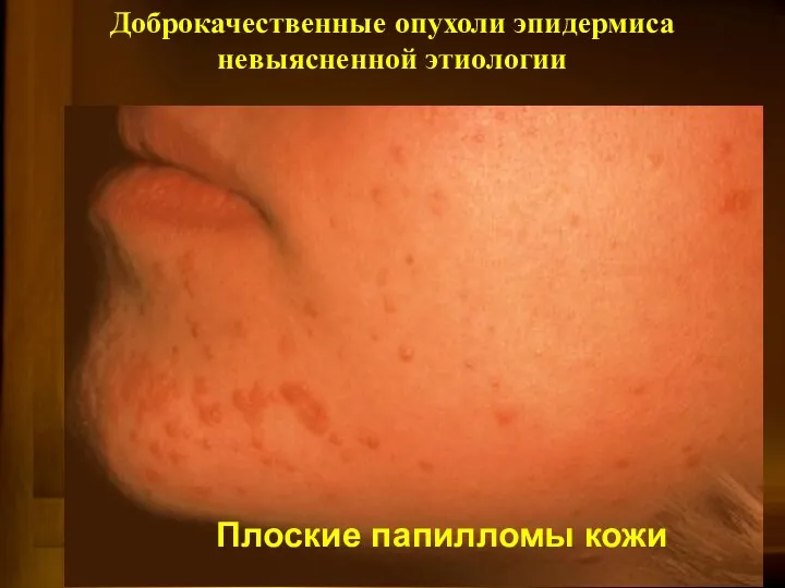 Плоские папилломы кожи Доброкачественные опухоли эпидермиса невыясненной этиологии