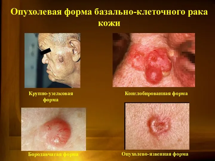 Опухолевая форма базально-клеточного рака кожи Крупно-узелковая форма Конглобированная форма Бородавчатая форма Опухолево-язвенная форма