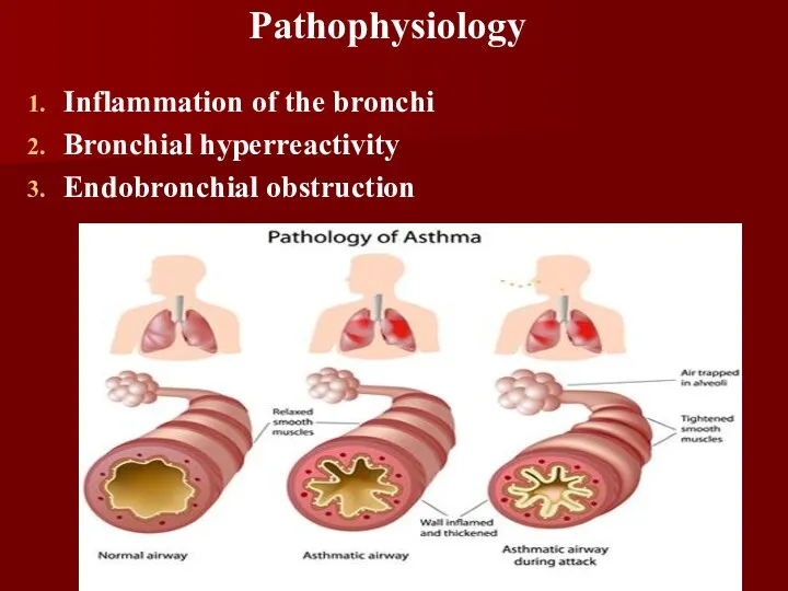 Pathophysiology Inflammation of the bronchi Bronchial hyperreactivity Endobronchial obstruction