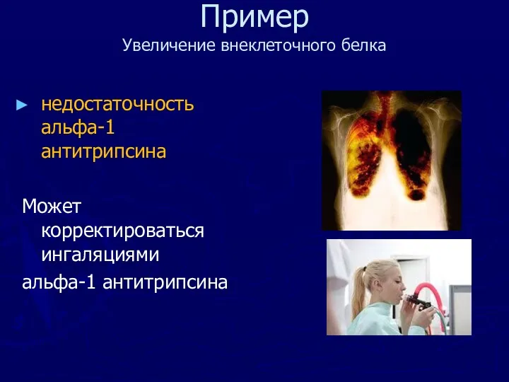 Пример Увеличение внеклеточного белка недостаточность альфа-1 антитрипсина Может корректироваться ингаляциями альфа-1 антитрипсина