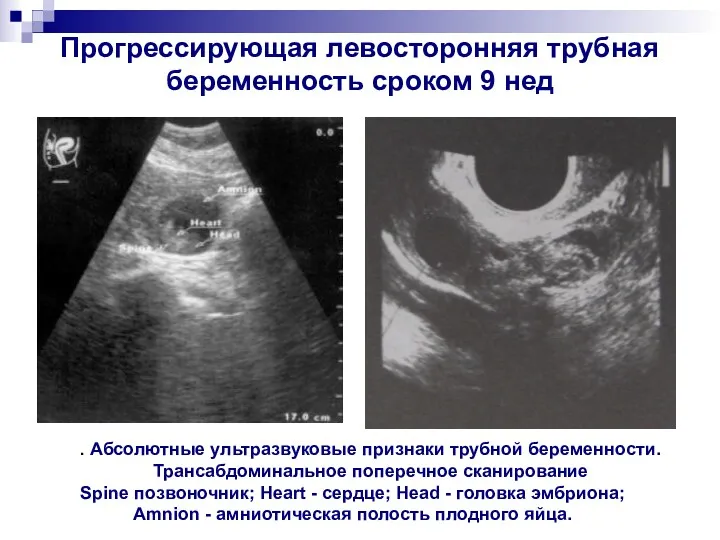 Прогрессирующая левосторонняя трубная беременность сроком 9 нед . Абсолютные ультразвуковые