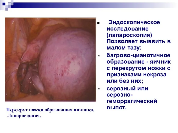 Эндоскопическое исследование (лапароскопия) Позволяет выявить в малом тазу: багрово-цианотичное образование