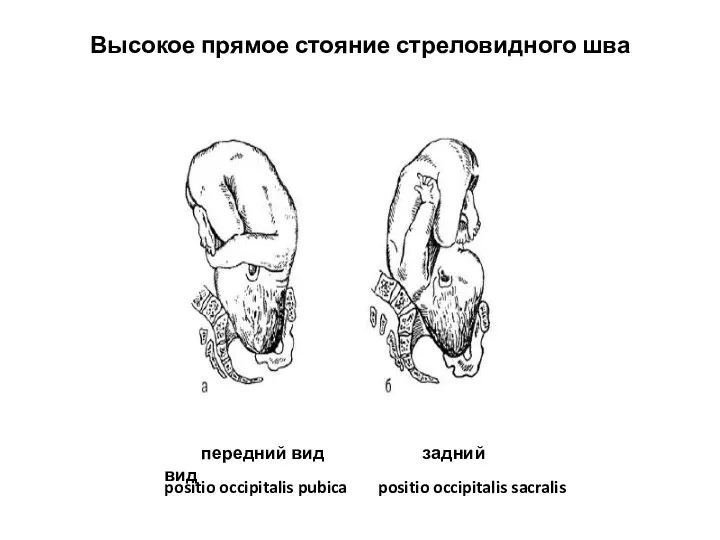Высокое прямое стояние стреловидного шва передний вид задний вид positio occipitalis pubica positio occipitalis sacralis