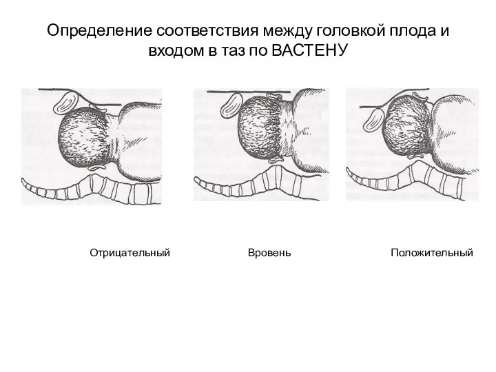 Определение соответствия между головкой плода и входом в таз по ВАСТЕНУ Отрицательный Вровень Положительный