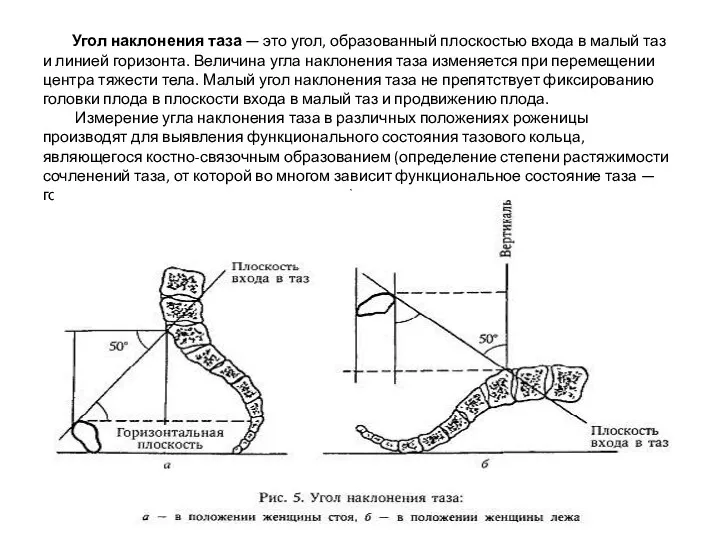 Угол наклонения таза — это угол, образованный плоскостью входа в